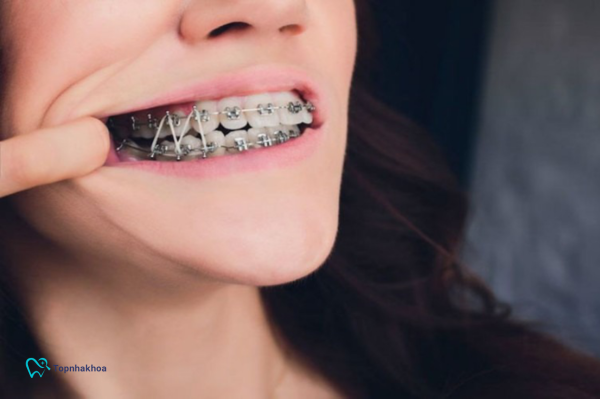 Tổng hợp các dụng cụ cơ bản trong chỉnh nha cần thiết nhất Thun liên hàm tuy nhỏ nhưng lại đóng vai trò cực kỳ quan trọng trong việc hoàn thiện khớp cắn