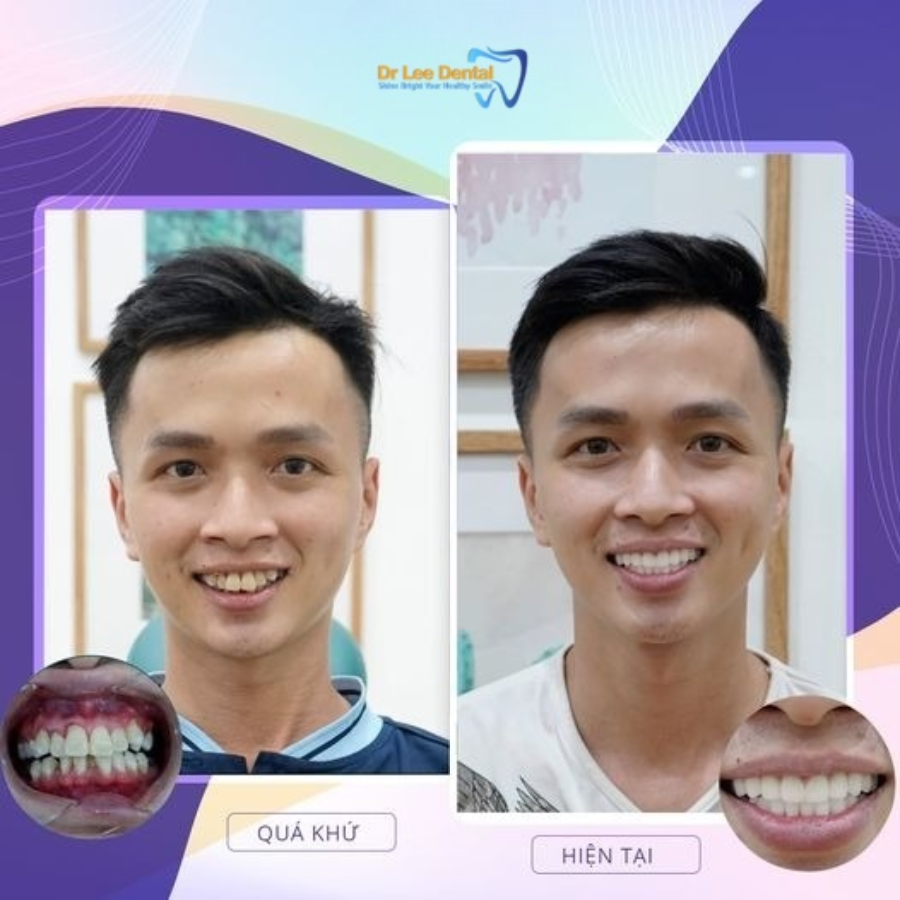 Hàm răng trắng thẳng đều chắc chắn của anh Toàn sau điều trị tại Dr Lee