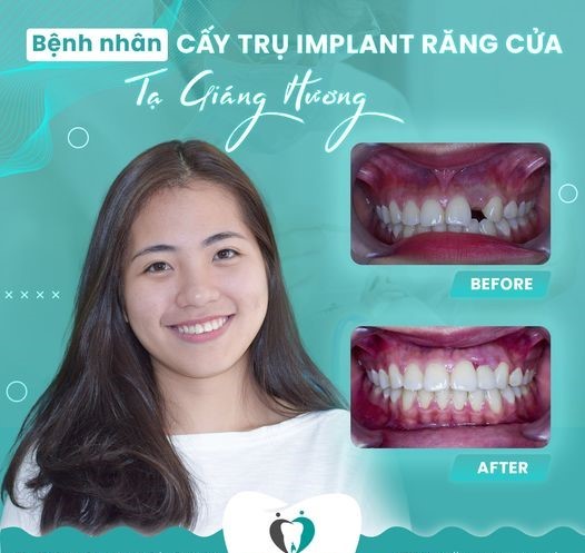 Chị Hương sở hữu răng mới tự nhiên, thẳng đều và hài hòa