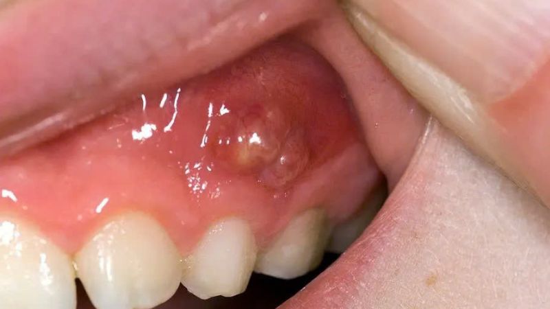 Áp xe răng sữa có nên nhổ răng không? Nguy cơ khi không xử lý kịp thời Áp xe răng sữa gây nhiễm trùng lan rộng, cần nhổ bỏ