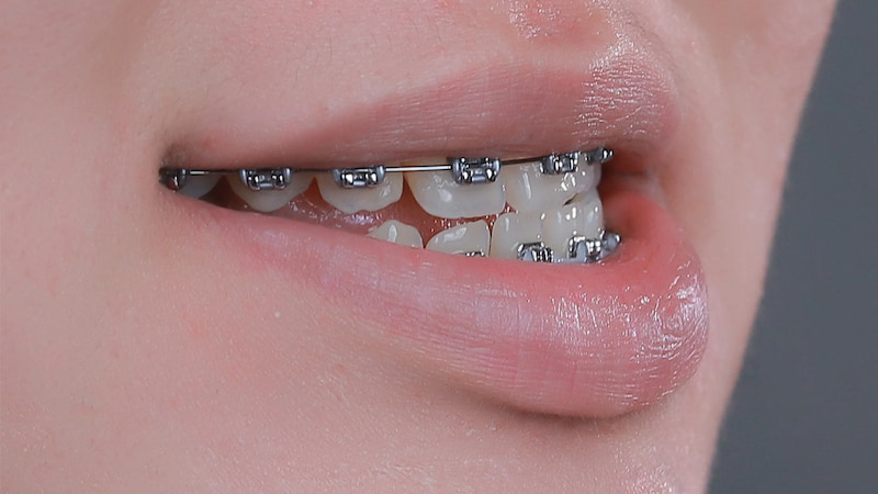 Bị móm có niềng răng được không? Phân tích từng trường hợp Thời gian niềng răng móm kéo dài trung bình từ 18-36 tháng