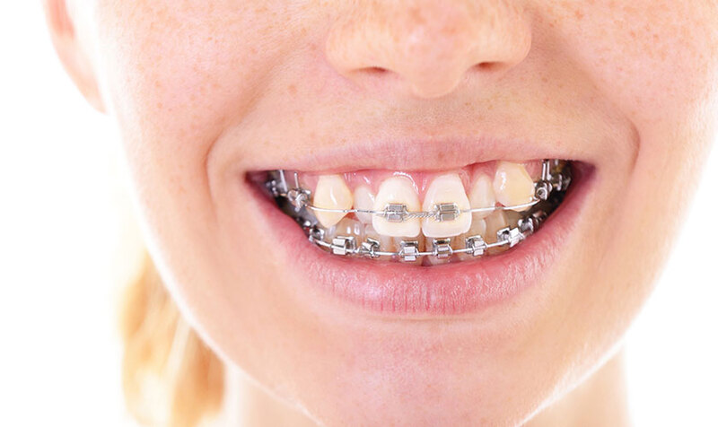 Không phải trường hợp nào cũng cần nhổ răng khi niềng răng khểnh.