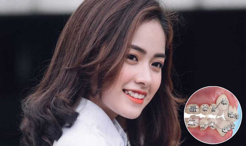 Đánh giá khớp cắn và răng khểnh trước khi quyết định niềng răng.