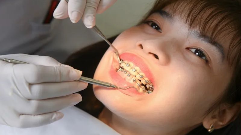Đi du học có niềng răng được không? Giải pháp an toàn cho bạn Chi phí tái khám cao nếu bạn niềng răng ở nước ngoài
