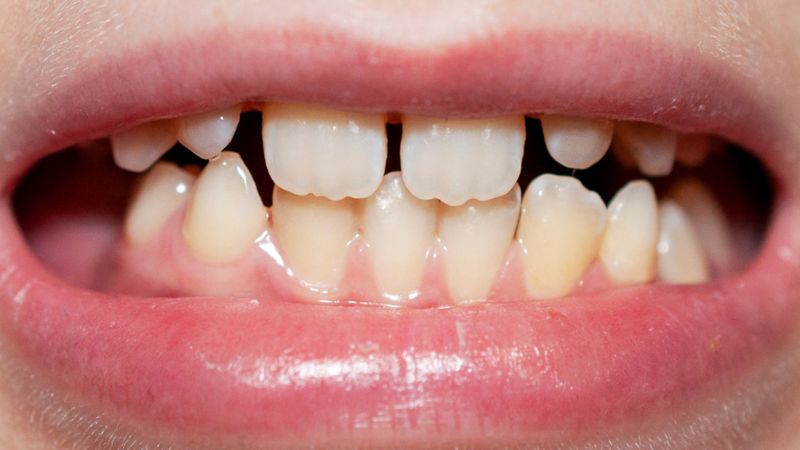 Đi du học có niềng răng được không? Giải pháp an toàn cho bạn Với trường hợp sai lệch khớp cắn không nên điều trị nếu định đi du học