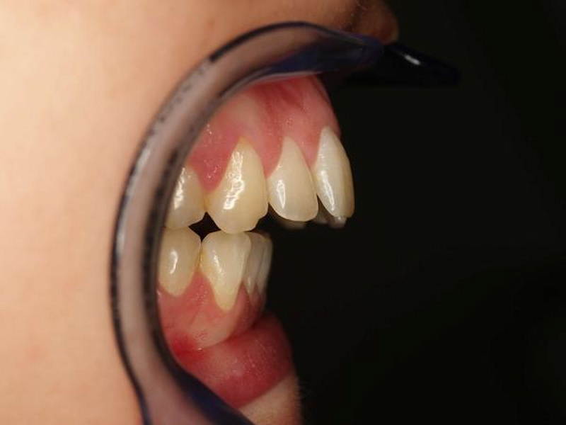 Hô hàm có niềng răng được không? Gợi ý giải pháp hiệu quả Niềng không phù hợp khi xương hàm trên phát triển quá mức gây hô nặng