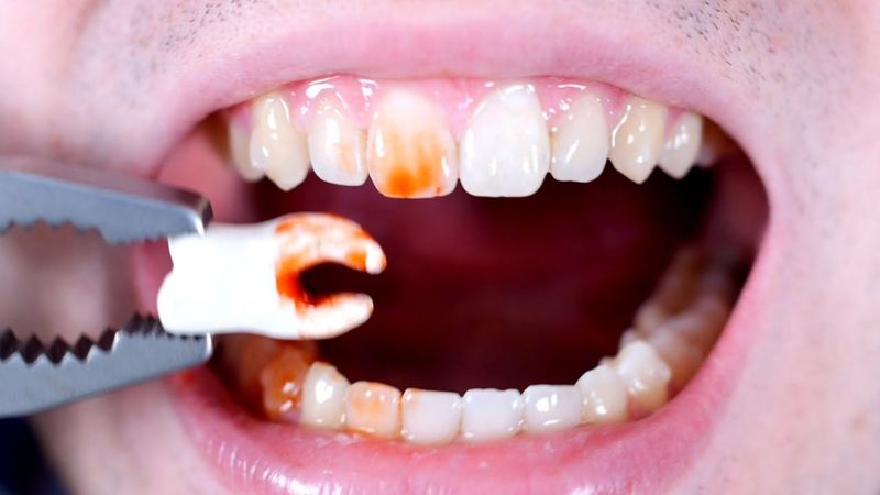 Giải mã ý nghĩa nằm mơ thấy tự nhổ răng sâu và cách hóa giải Nằm mơ thấy tự nhổ răng sâu cho thấy bạn đang có những thay đổi tích cực trong thời gian tới