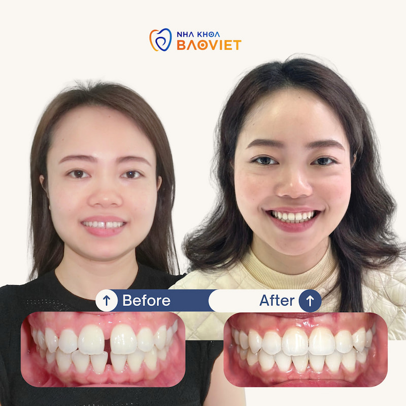 Chị My sở hữu hàm răng của đều đẹp, khít sát và hài hòa sau niềng