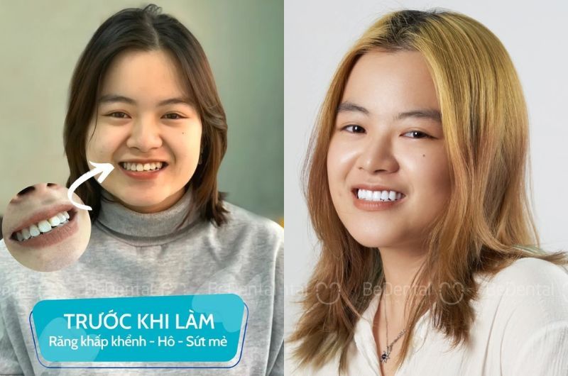 Nha khoa BeDental: Địa chỉ được khách hàng trong và ngoài nước tin chọn Răng đều, trắng sáng tự nhiên của chị khách sau khi làm răng tại BeDental