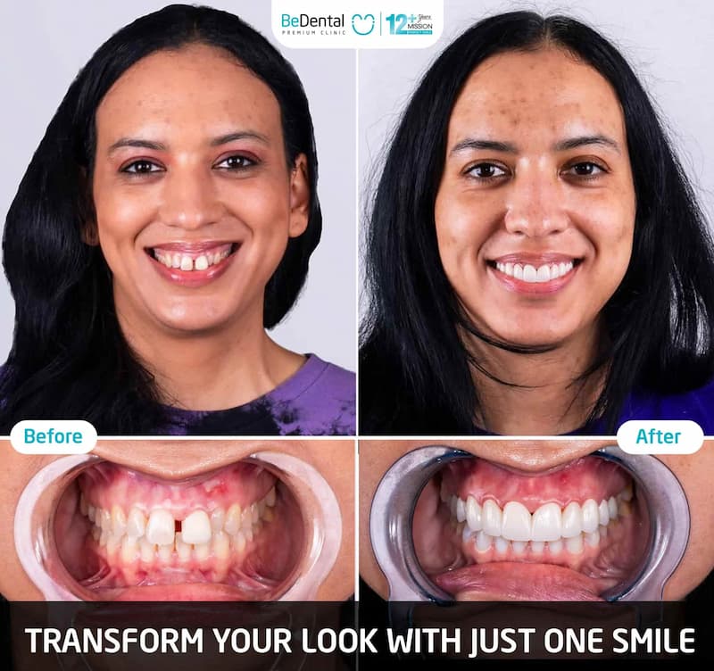 Nha khoa BeDental: Địa chỉ được khách hàng trong và ngoài nước tin chọn Khách hàng quốc tế điều trị tại nha khoa