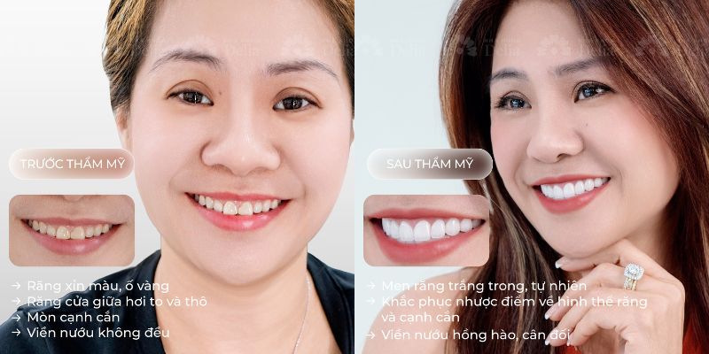 Nha khoa Delia chuẩn Đức 5 sao cho nụ cười an tâm dài lâu Hàm răng mới trắng trong tự nhiên chắc chắn của chị khách sau làm răng tại Delia