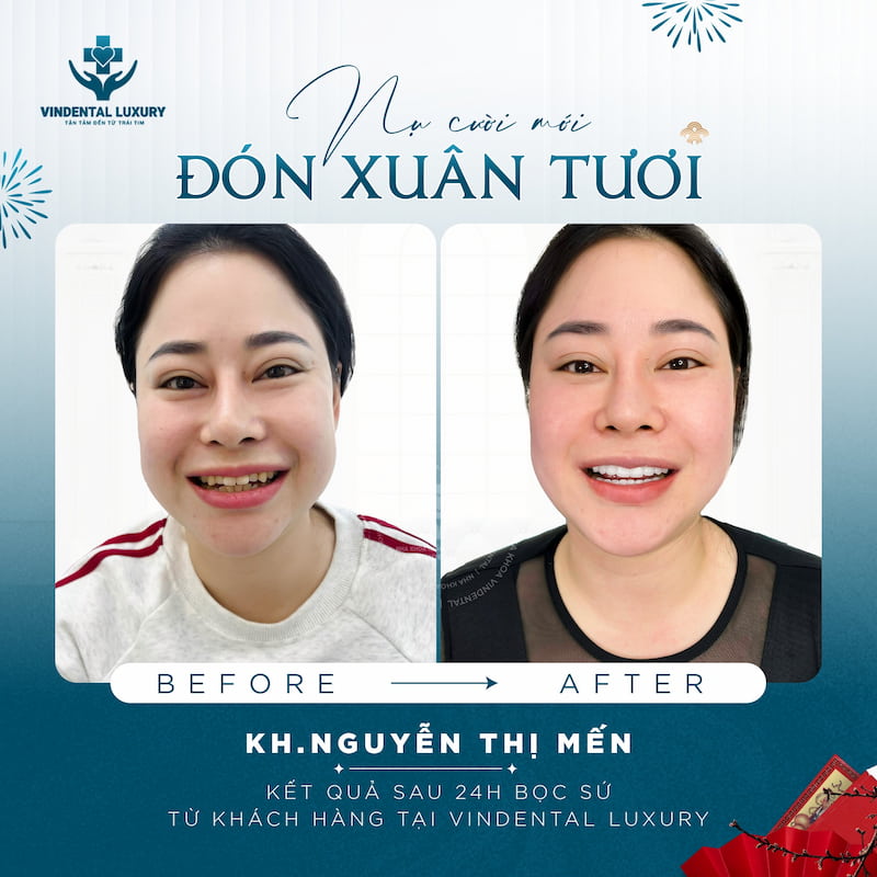 Nha khoa Vindental Luxury: Đẳng cấp thẩm mỹ nụ cười chuẩn quốc tế Răng trắng sáng đều đẹp tự nhiên của chị Mến sau bọc sứ