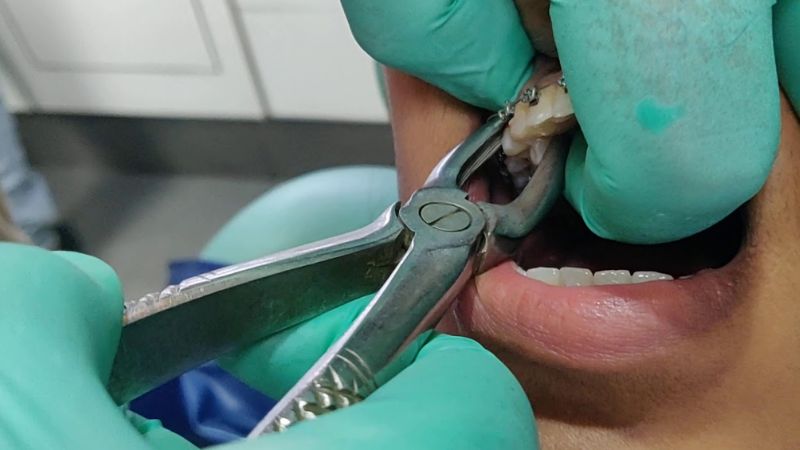 Nhổ răng chết tủy có đau không? Bao lâu thì hết đau? nhổ răng chết tủy có đau không? Nhổ răng chết tủy nếu được thực hiện đúng kỹ thuật thì không gây đau đớn