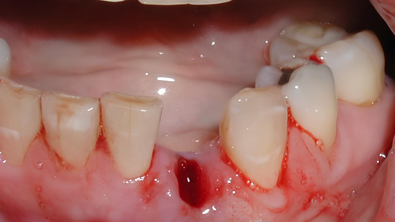 Nhổ răng có ăn xôi được không? Bật mí chế độ ăn uống an toàn Ăn xôi đòi hỏi lực nhai mạnh khiến bật cục máu đông, dẫn đến dễ viêm, đau