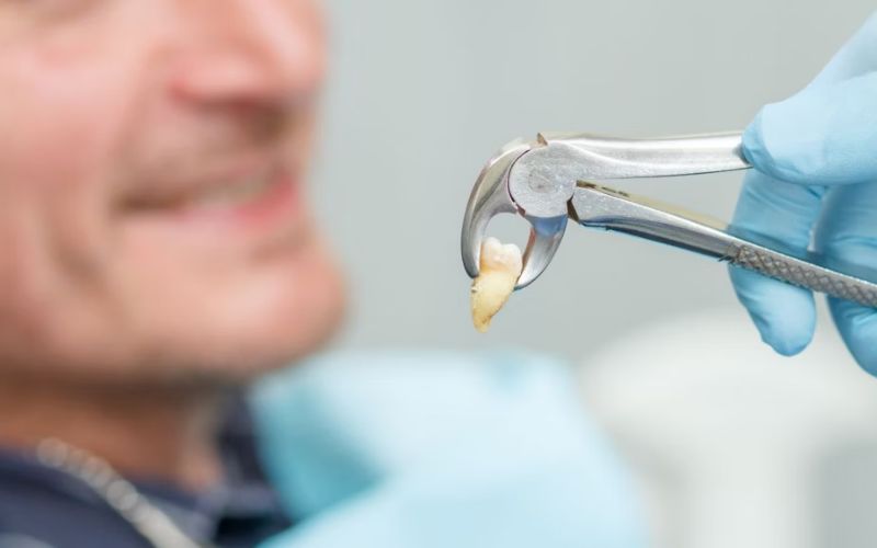 Giải đáp nhổ răng khôn có được bảo hiểm nhân thọ không? Nhổ răng khôn có được bảo hiểm nhân thọ không tuỳ vào từng trường hợp