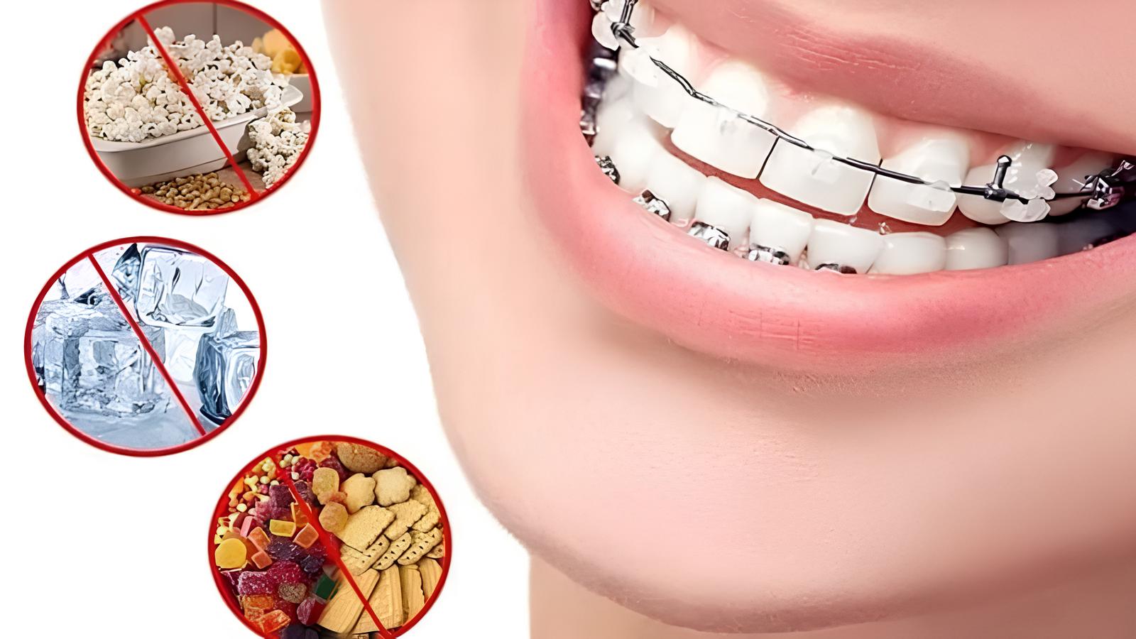 Niềng răng có ăn uống bình thường được không? Thực đơn "chuẩn" Niềng răng có ăn uống bình thường được không? Niềng răng có thể ăn uống bình thường nhưng phải điều chỉnh lại loại thức ăn dung nạp