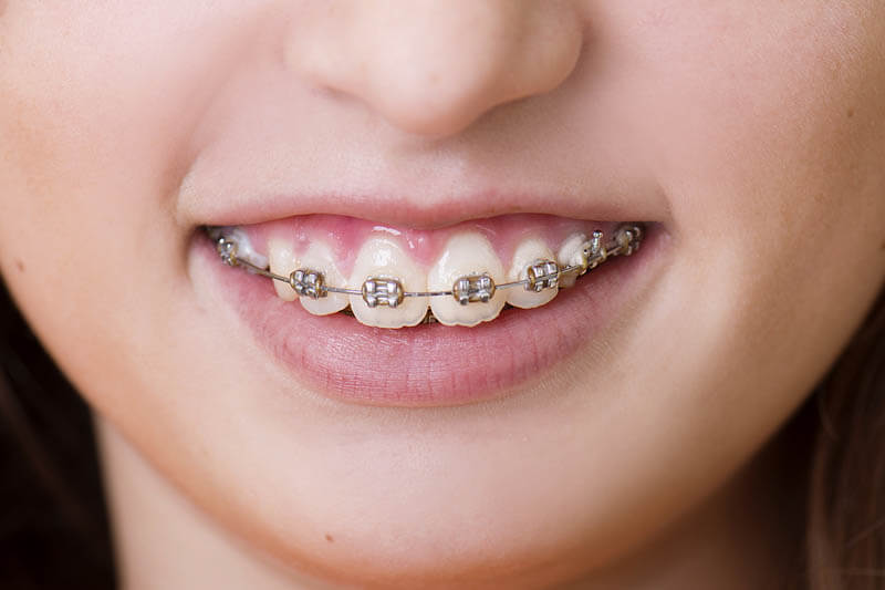 Thông qua hệ thống mắc cài hoặc khay tạo lực kéo đưa răng cửa lùi vào trong