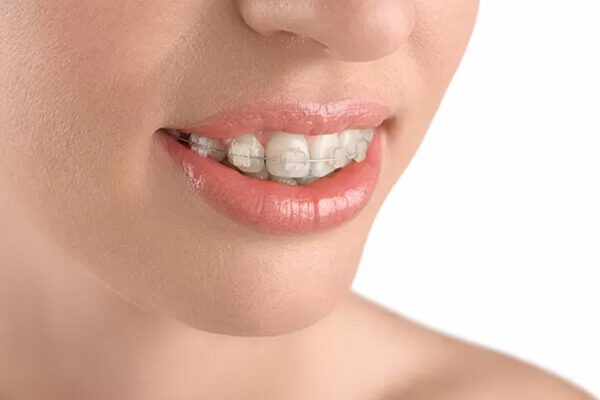 Mắc cài sứ mang lại hiệu quả cao với người hô nhẹ và trung bình 