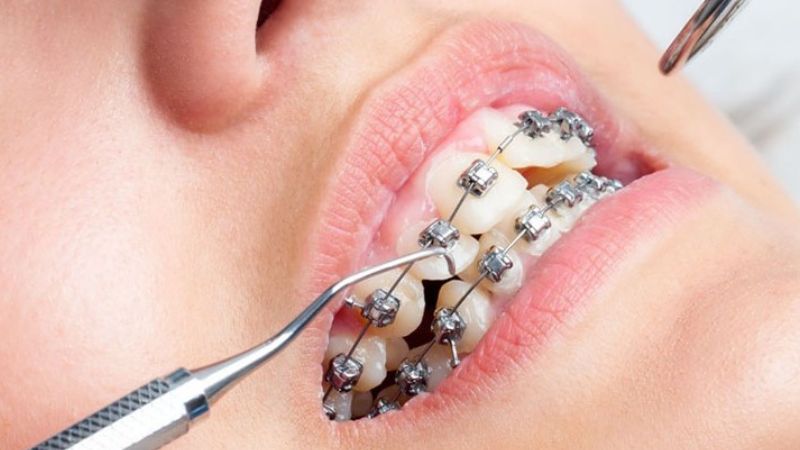 Niềng răng có đi máy bay được không? 3 Lưu ý quan trọng Trường hợp vừa siết răng thì nên hạn chế di chuyển bằng máy bay