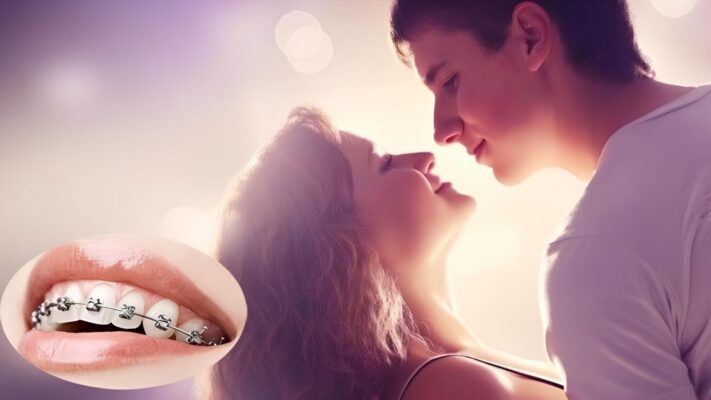 Niềng răng có hôn nhau được không? Cách hôn an toàn