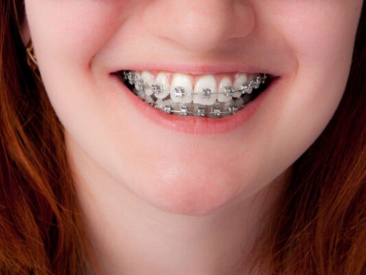 Khi mới gắn mắc cài dễ xuất hiện cảm giác ê buốt đau tức