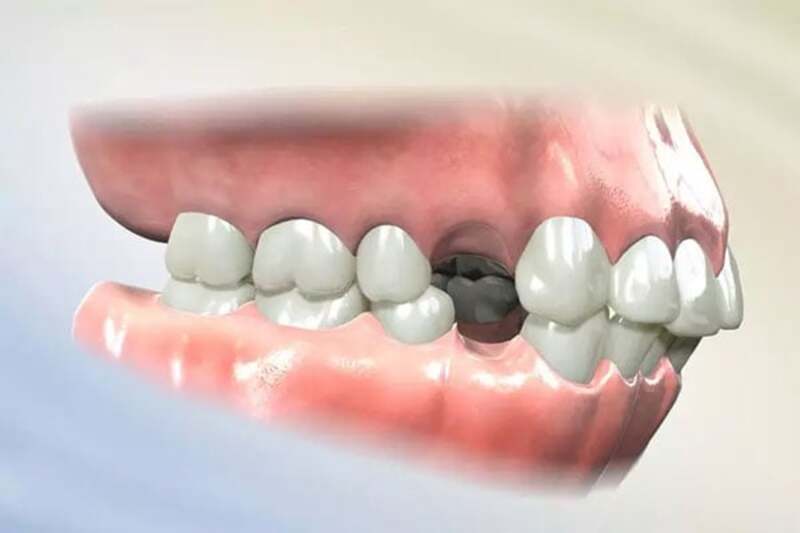 Niềng răng invisalign có cần nhổ răng không? Bác sĩ giải đáp Bác sĩ nha khoa thường chỉ định nhổ răng số 4 hoặc số 5 khi niềng răng Invisalign.