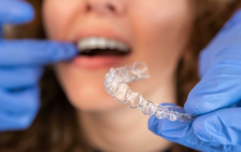 Niềng răng Invisalign có đau không? Mức độ đau thực tế Đeo khay đủ 20-22 giờ mỗi ngày và không tháo khay khi vừa thấy đau