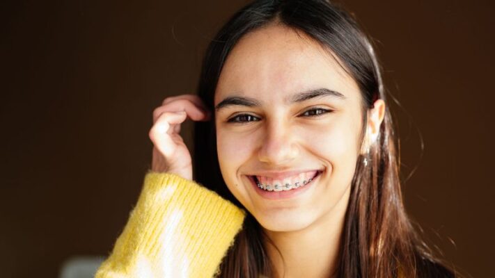 Niềng răng khểnh mất bao lâu? Phương pháp rút ngắn thời gian niềng