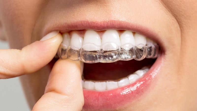 Giải đáp: Niềng răng silicon cho người lớn có hiệu quả không? Niềng răng silicon cho người lớn có hiệu quả không? Niềng răng silicon không đạt hiệu quả tốt với người trưởng thành