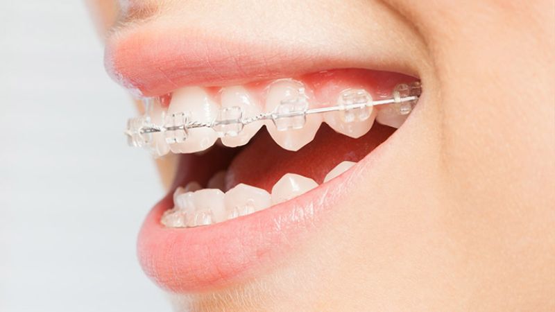 Giải đáp: Niềng răng silicon cho người lớn có hiệu quả không? Niềng răng silicon không thay thế được mắc cài hay khay chỉnh nha