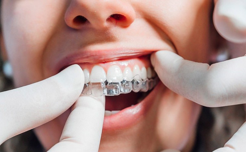 Niềng răng trong suốt Leetray và thông tin nhất định phải biết Nha khoa sẽ kiểm tra tổng thể để kết thúc quá trình chỉnh nha