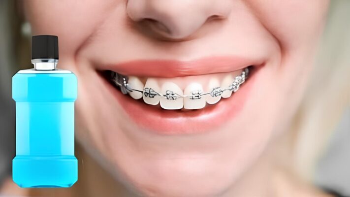 Top 9 nước súc miệng cho người niềng răng được bác sĩ khuyên dùng