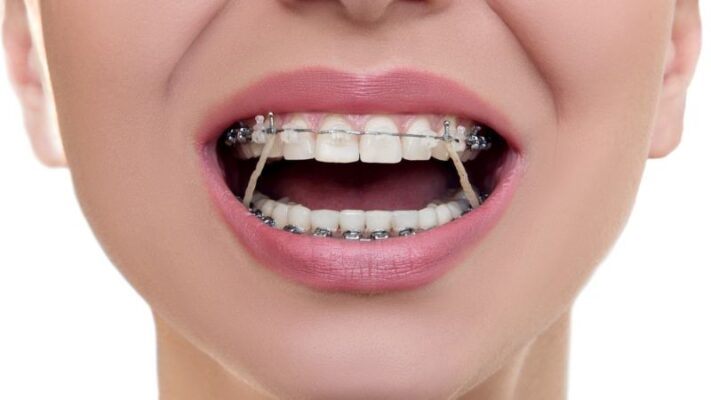 Nuốt dây thun niềng răng có sao không? Cách phòng tránh hiệu quả