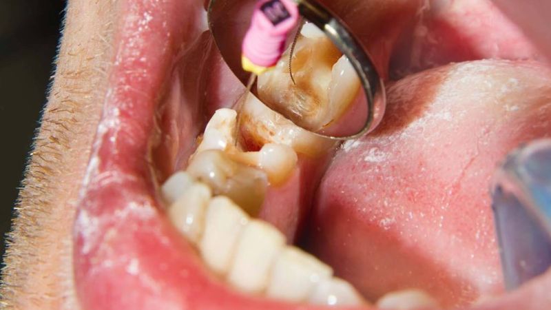 Răng chết tủy có nên nhổ không? Nguy cơ khi giữ răng chết tủy Răng chết tủy có nên nhổ không? Răng chết tủy cần nhổ nếu không còn khả năng ăn nhai