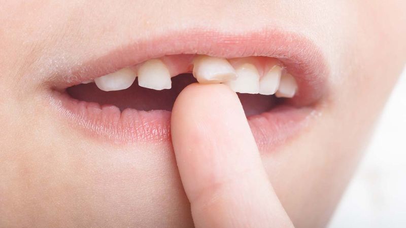 Răng chết tủy có nên nhổ không? Nguy cơ khi giữ răng chết tủy Những răng đã lung lay độ 2 - 3 thì nhổ răng là giải pháp tối ưu