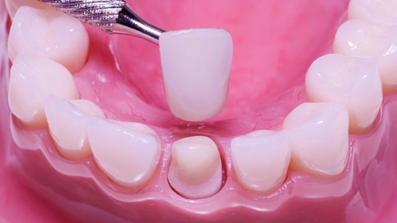 Răng chết tủy có nên nhổ không? Nguy cơ khi giữ răng chết tủy Những chiếc răng có thể bọc sứ thì không cần nhổ