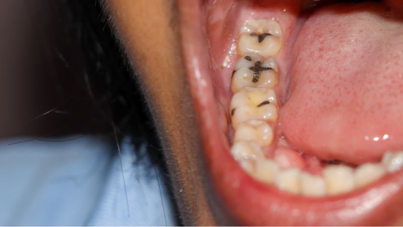 Răng sâu có niềng được không? Lưu ý an toàn khi chỉnh nha Răng sâu có niềng được không? Người bị răng sâu hoàn toàn có thể thực hiện chỉnh nha