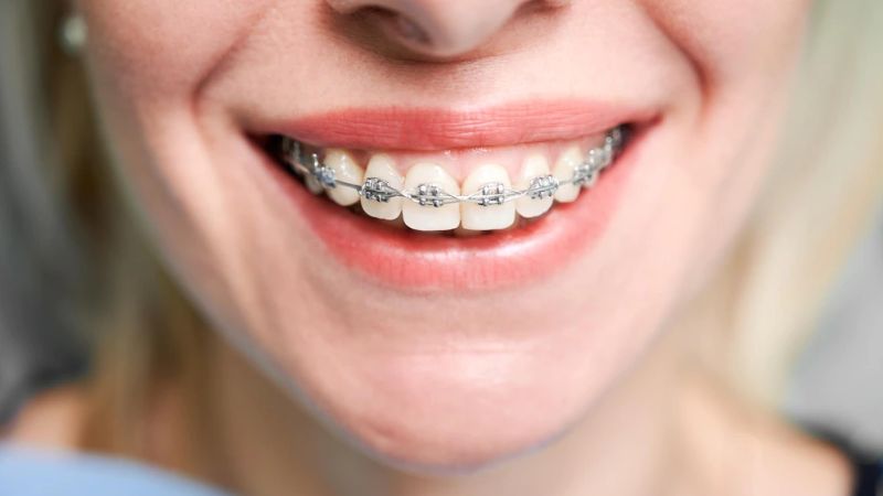 Răng thỏ có niềng được không? Phương pháp niềng răng hiệu quả Răng thỏ có niềng được không? Người có răng thỏ hoàn toàn có thể cải thiện bằng phương pháp niềng răng