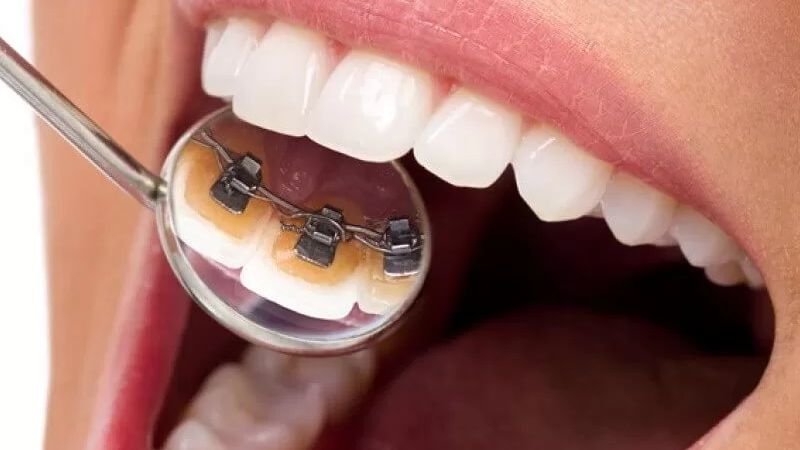 Răng thỏ có niềng được không? Phương pháp niềng răng hiệu quả Niềng răng mặt trong là phương pháp hiệu quả cho người có răng thỏ