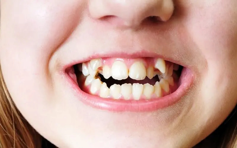 Review niềng răng không mắc cài từ trải nghiệm thực tế Niềng răng trong suốt kém hiệu quả trong trường hợp răng sai lệch phức tạp