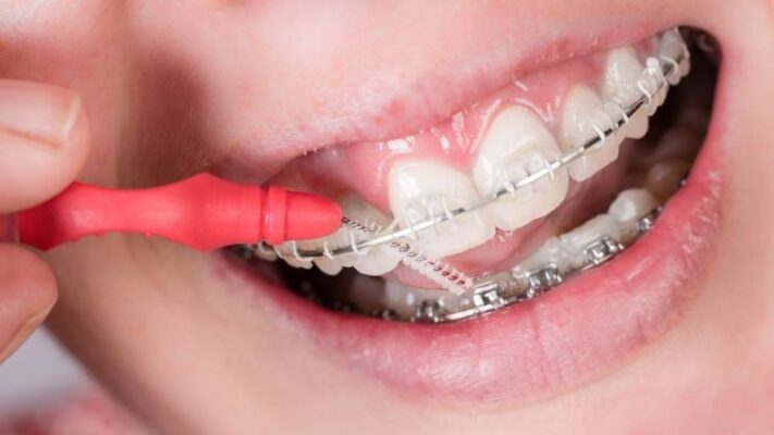 Bị tụt lợi có niềng răng được không? Kinh nghiệm niềng răng an toàn