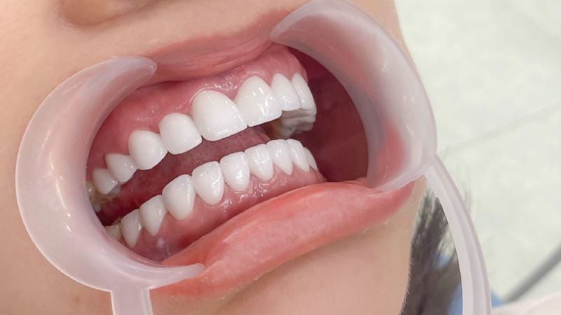 17 tuổi bọc răng sứ được không? Đâu là giải pháp an toàn? 17 tuổi bọc răng sứ được không? Ở độ tuổi 17 xương hàm vẫn chưa đạt được sự ổn định lâu dài