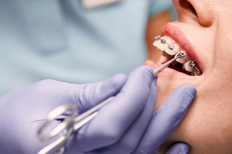 25 tuổi niềng răng được không? Trường hợp nào nên niềng? Niềng răng ở tuổi 25 dễ xây dựng phác đồ chỉnh nha chính xác