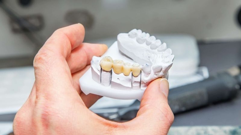 Bắc cầu răng sứ có bền không? Các yếu tố quyết định độ bền Kỹ thuật làm cầu chuẩn sẽ tăng độ bền cho cầu răng sứ