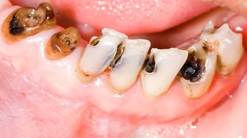 Bọc răng sứ bao lâu thì phải làm lại? Cách kéo dài tuổi thọ Không làm lại răng sứ kịp thời có nguy cơ dẫn đến biến chứng sâu răng