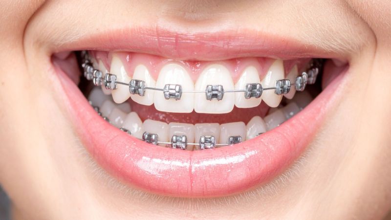 Bọc răng sứ có niềng răng được không? Lưu ý "vàng" từ chuyên gia Người không mắc bệnh lý răng miệng, khi bọc răng sứ vẫn có thể niềng răng