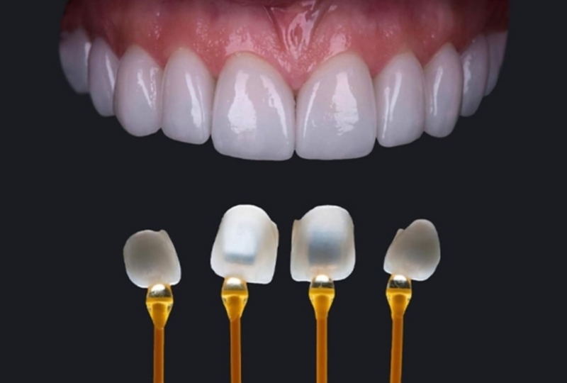 Bọc răng sứ có tuổi thọ bao lâu? 5 Yếu tố quyết định độ bền Răng sứ E.max chịu lực tốt, độ bền cao lên tới 10-20 năm