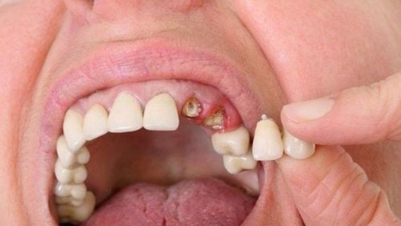 Chỉ còn chân răng có bọc sứ được không? Lưu ý khi bọc sứ Trường hợp chỉ còn chân răng nhưng bị tiêu xương nhiều không đủ điều kiện bọc sứ