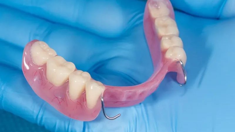 Chỉ còn chân răng có bọc sứ được không? Lưu ý khi bọc sứ Phục hình bán phần là giải pháp thay thế hiệu quả khi chân răng không thể bọc sứ