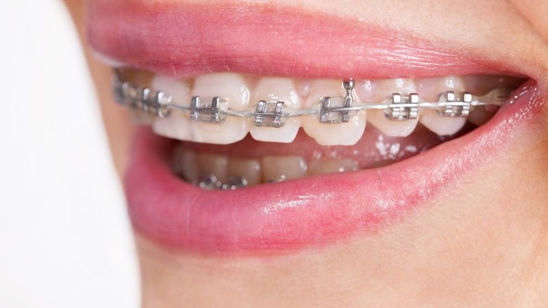 Giá niềng răng hô bao nhiêu tiền? Yếu tố quyết định mức giá Giá niềng răng hô được áp dụng dao động từ 10.000.000 - 135.000.000 VNĐ/ca